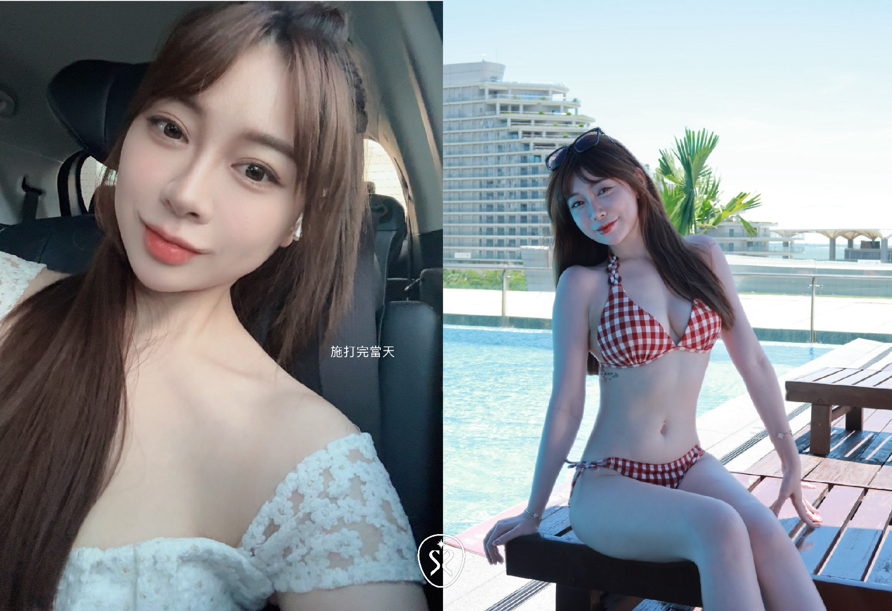 【玻尿酸法令紋】